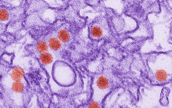 Children With Congenital Zika Virus Infection Face Serious Challenges As They Age