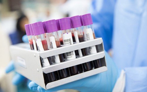 UC San Diego Health launches novel coronavirus blood testing to identify past exposure